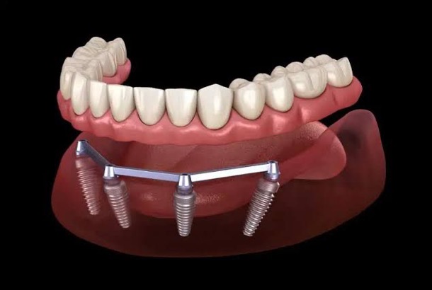Bar-Shaped Prosthetics