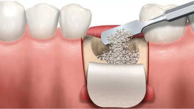 Bone Powder Application (Graft)