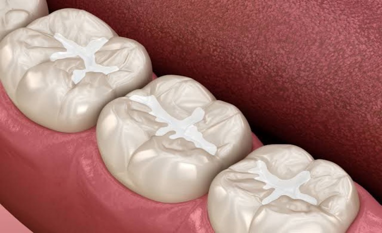 Fissure Sealant Application