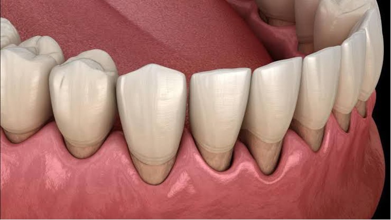 Receding Gums