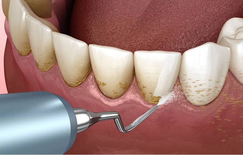 Detertrusion (Dental Stone Cleaning)