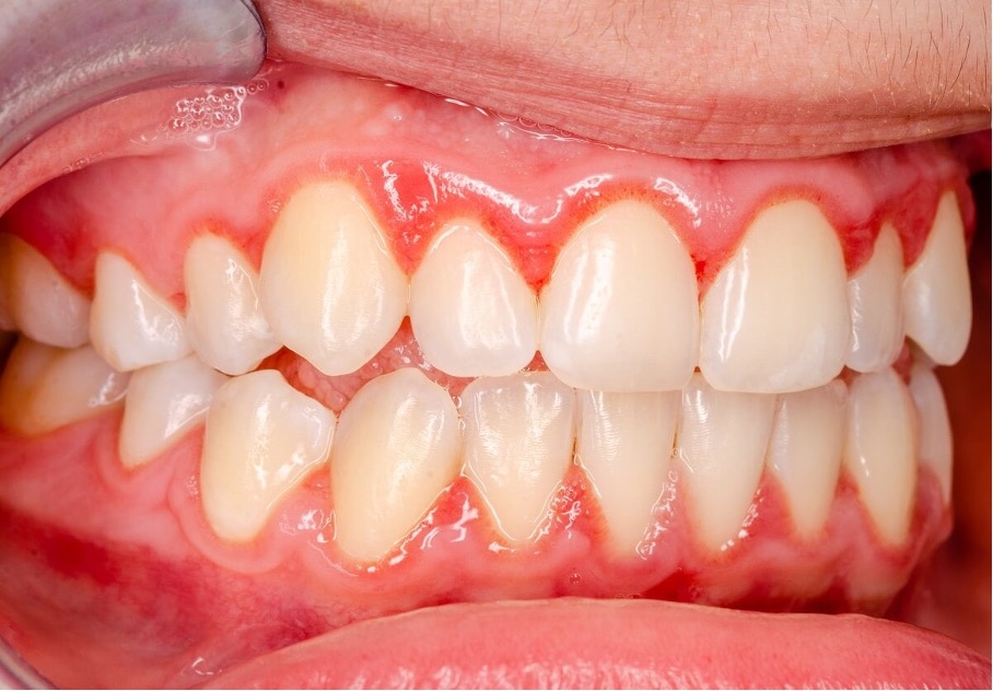 Bleeding Gums