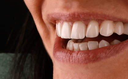 E-Max Crowns