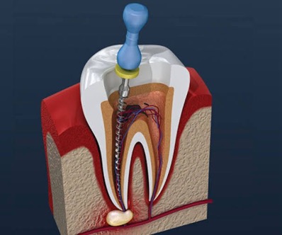 Root Canal Treatment