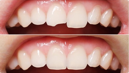 Aesthetic Fillings