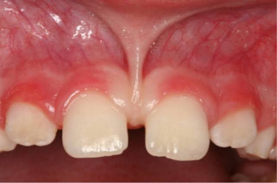 Frenectomy