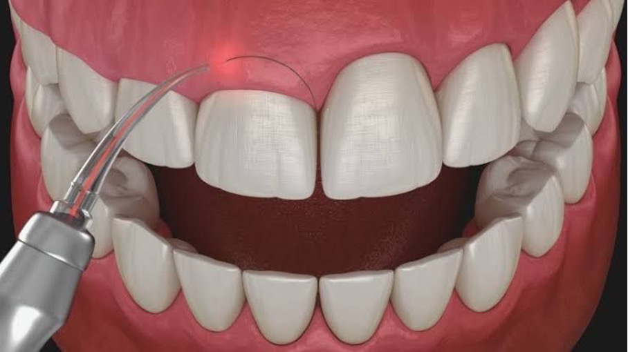Gingivectomy / Gingivoplasty
