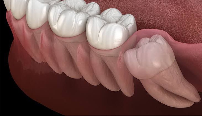 Impacted Tooth Extraction
