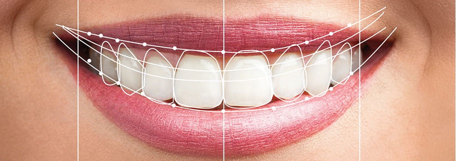 Smile Design