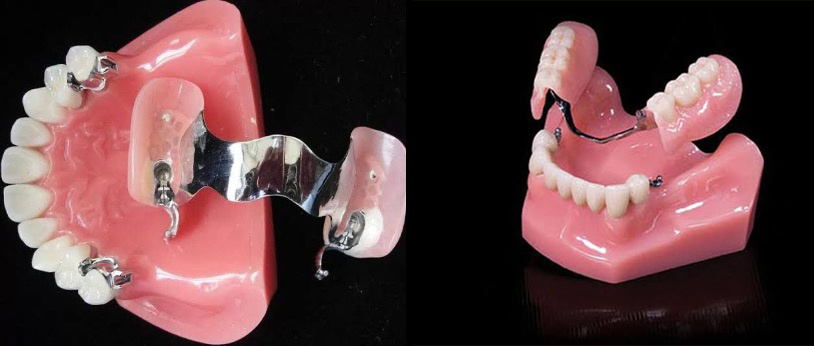 Precision Attachment Prostheses (Snap Prostheses)