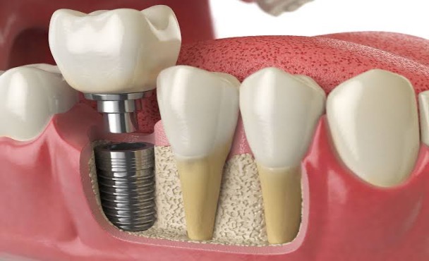 Implant Treatment