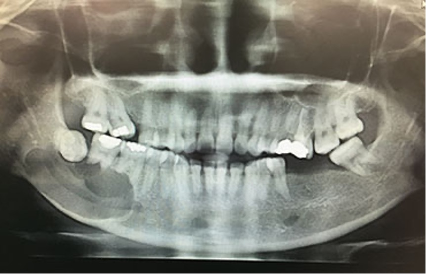 Cyst Surgery