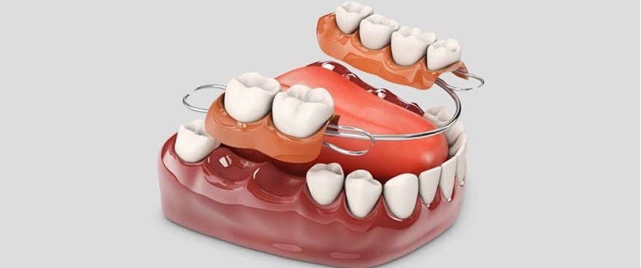 Partial Dentures (Hooked Dentures)