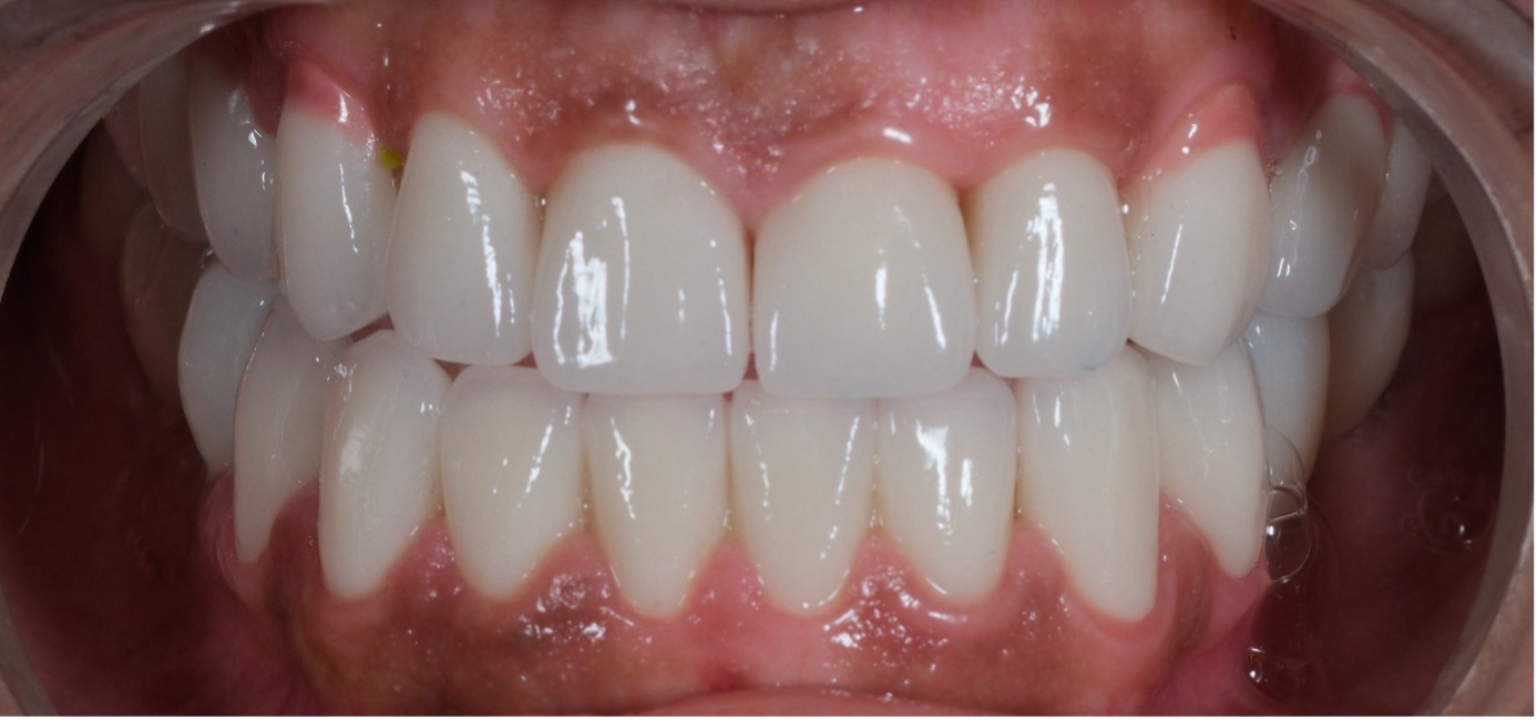 Zirconium Crowns